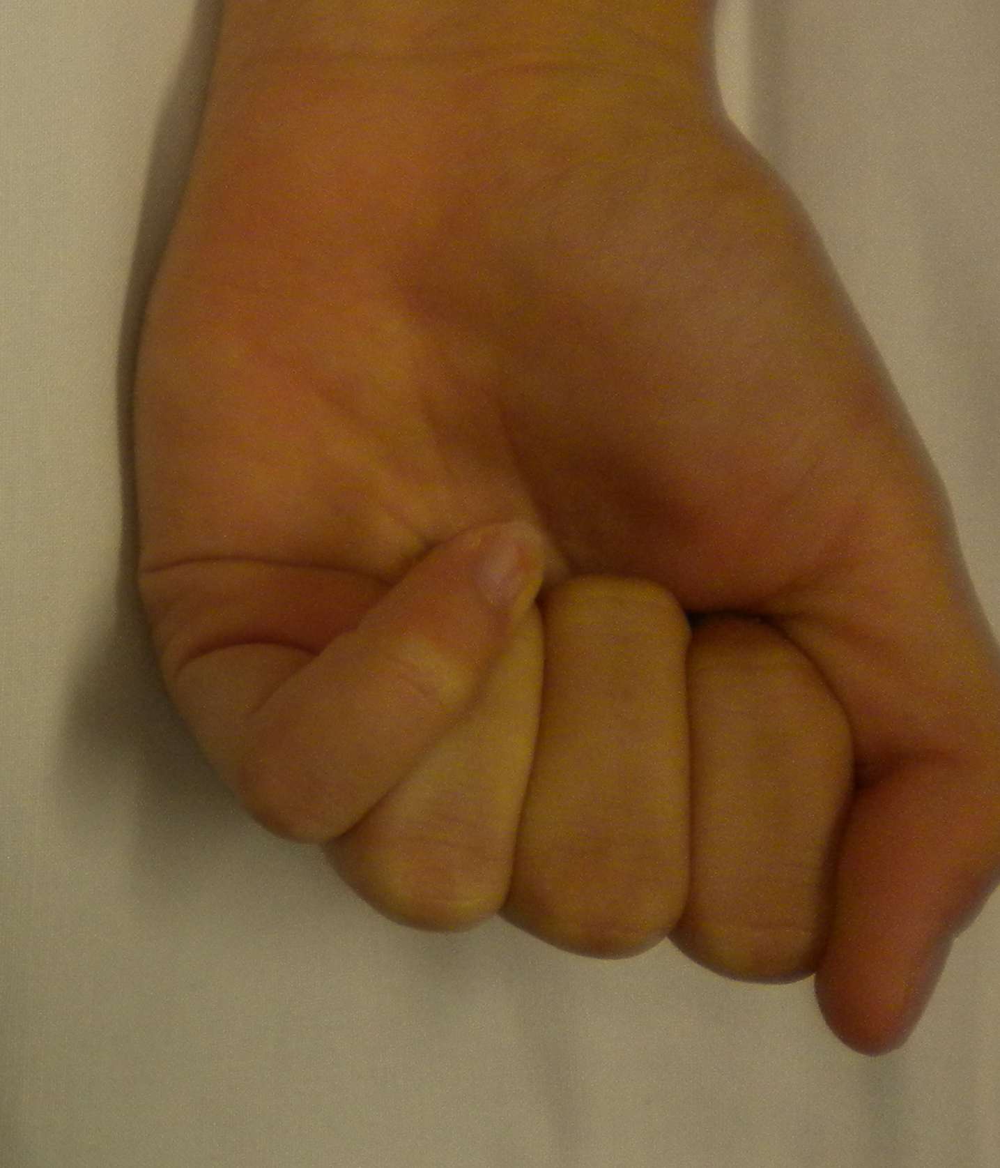 Finger Malrotation